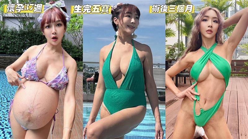 李宓完成腹直肌縫合與腹部拉皮三個月對比照曝光恢復路艱辛卻充滿感動