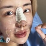 雪碧术后10天拆线自拍公开 拆鼻板后鼻型走向引发热议