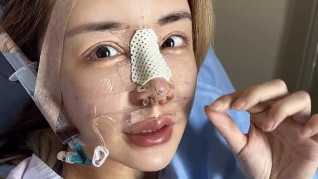 雪碧术后10天拆线自拍公开 拆鼻板后鼻型走向引发热议